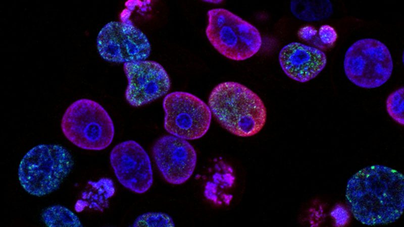 cbd cancer : quels sont les effets du cannabidiol sur les cellules cancéreuses
